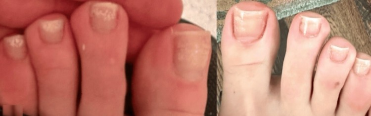 Uñas de los pies antes y después de 10 meses de tratamiento tópico con terbinafina mostrando una mejoría notable