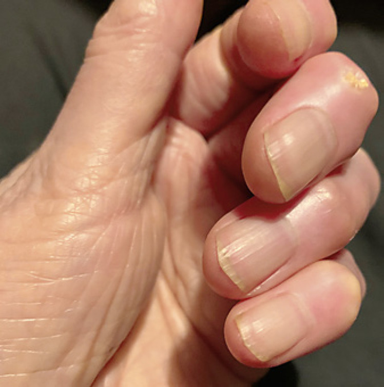 Uña de la mano aclarada después de 6 meses de tratamiento antimicótico