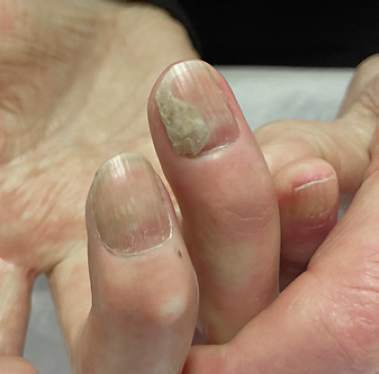 Uña de la mano con infección por hongos antes del tratamiento