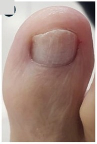 Uña del pie completamente aclarada después del tratamiento con terbinafina