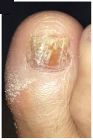 Uña del pie severamente infectada antes del tratamiento con terbinafina