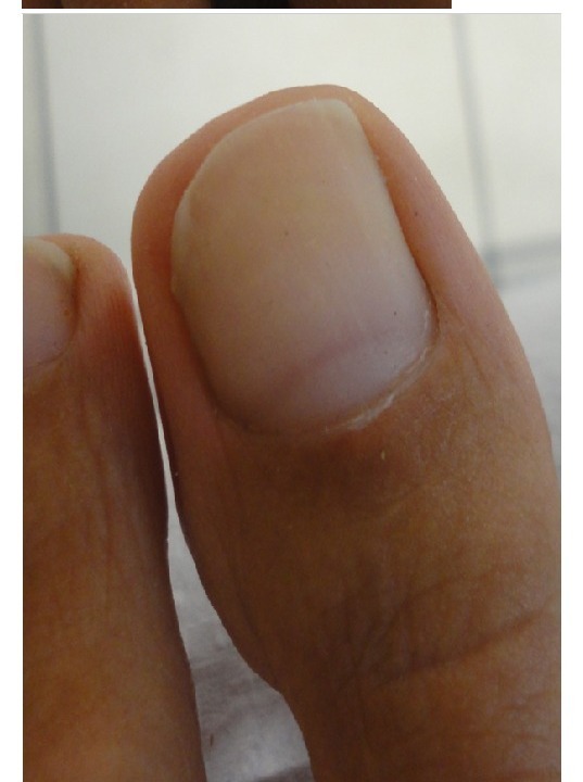Uña del pie aclarada después del tratamiento antimicótico mostrando 91% de mejora