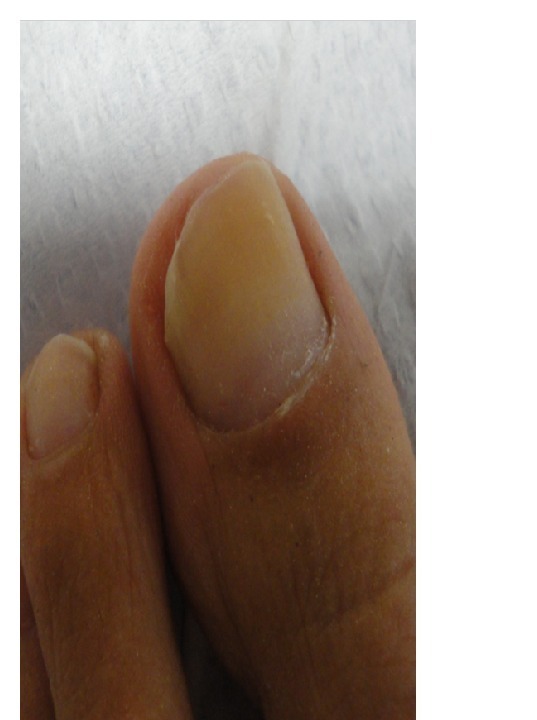 Uña del pie con decoloración amarilla antes del tratamiento antimicótico
