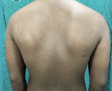 Mismo paciente con piel despejada después de 6 semanas de tratamiento con receta