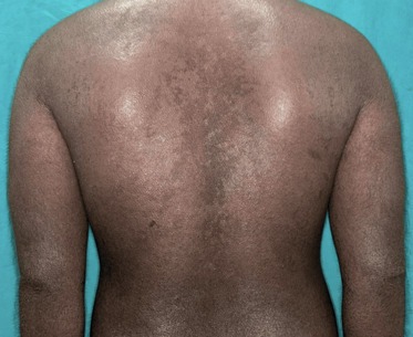 Eczema severo en la espalda antes del tratamiento