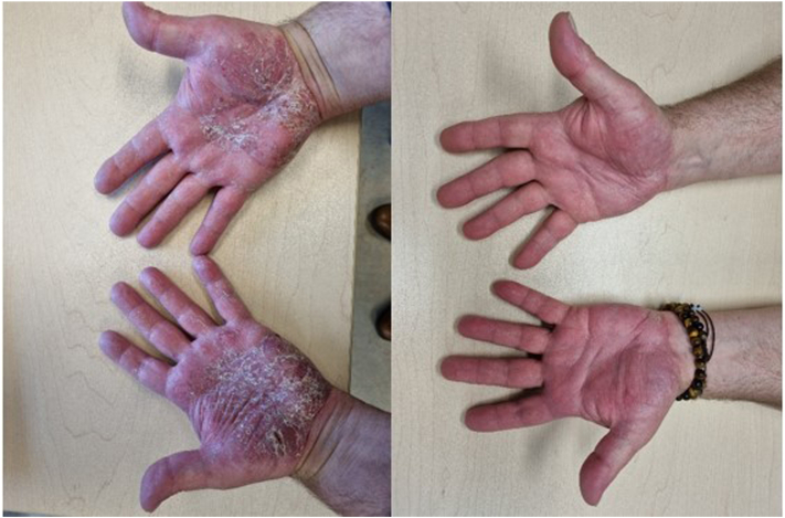 Psoriasis palmoplantar eliminada con roflumilast tópico al 0.3%